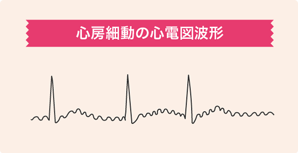 心房細動の心電図波形